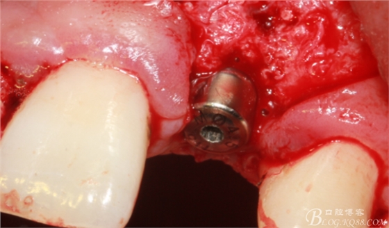 一例上前牙种植失败病例的补救（梁光强）