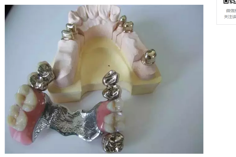 套筒冠义齿是指利用套筒冠的双重冠结构把上部义齿与基牙连接起来的