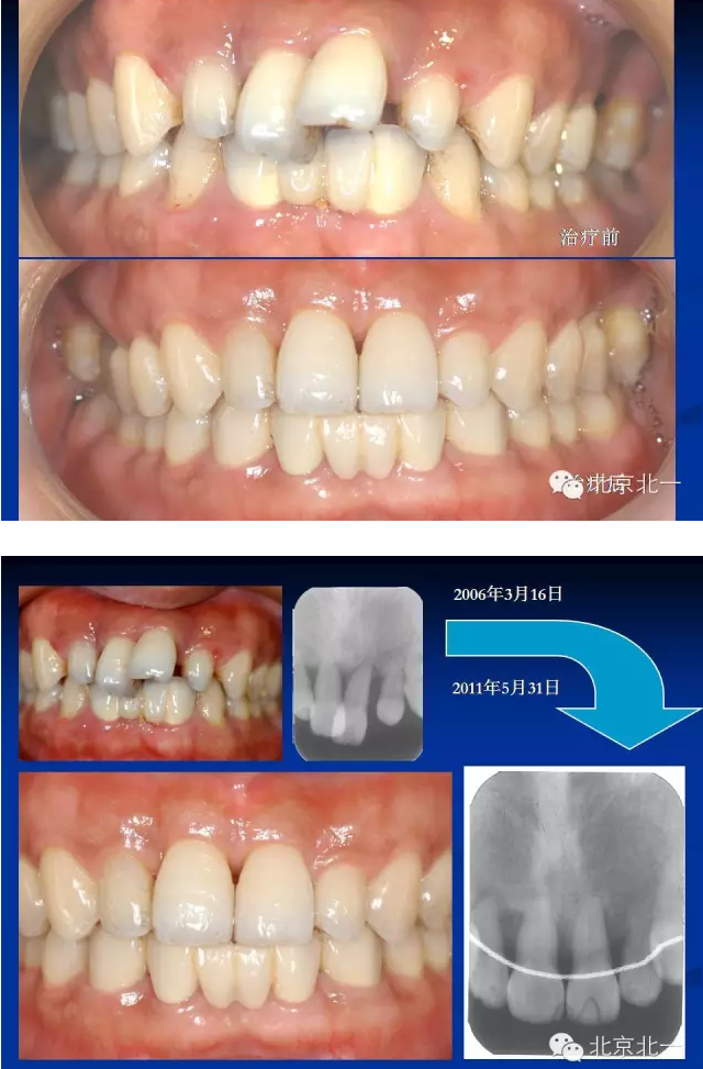 牙周基础治疗的临床病例介绍