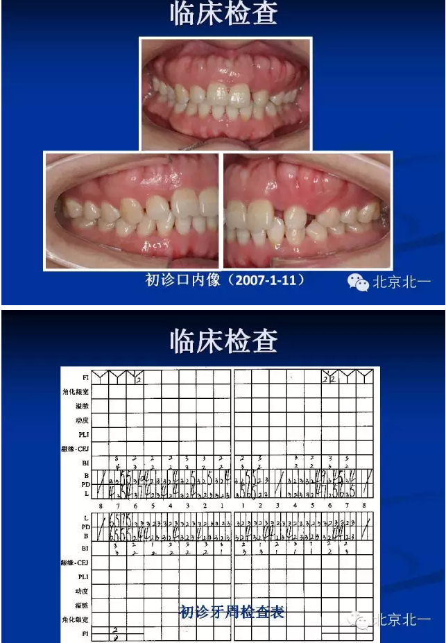 牙周基础治疗的临床病例介绍