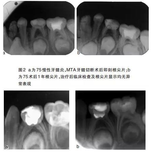 儿牙 乳牙活髓保存治疗——张笋副教授 3, 乳牙牙髓切断术常用药物