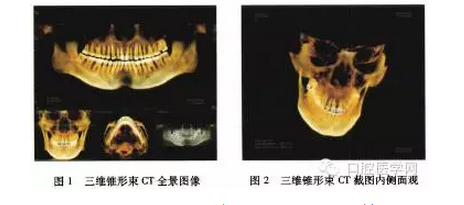 治疗:阿替卡因肾上腺素局部麻醉下行左侧上颌第三磨牙 多生牙拔除术