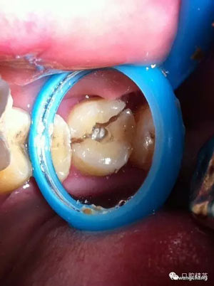 牙劈裂修复病例