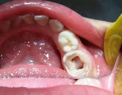 关爱儿牙 乳牙牙髓病的实用治疗  治疗步骤:1)去龋,开髓 4)根充,乳牙