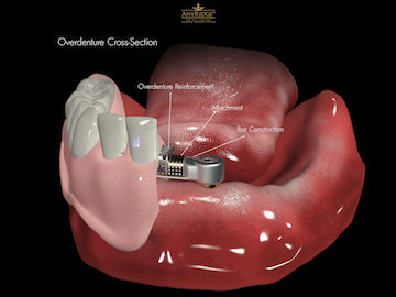 over dentures, (2 implants) 2颗种植体,球帽固位,可摘覆盖义齿