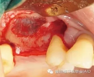 口腔种植上颌窦提升术临床要点