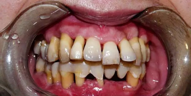 1例重度牙周炎的治疗