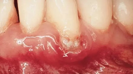 这十种常见口腔疾病，你有遇到过么？