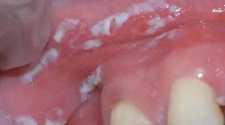鹅口疮是一种真菌感染,看起来像口腔中的白色薄膜.