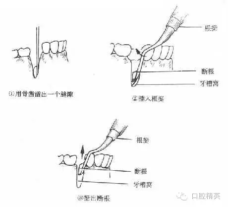 拔牙术【知识大全】(exodontia)