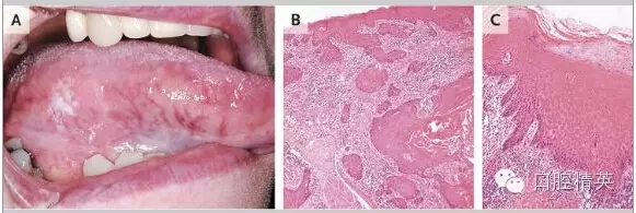 舌鳞状细胞癌