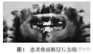 颌骨骨髓炎X线影像