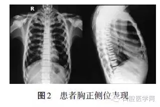 颌骨骨髓炎X线影像