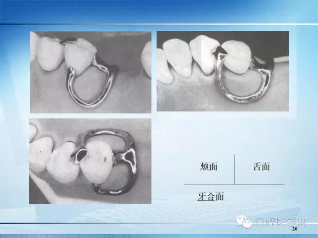 义齿技术 【多图】可摘局部义齿-卡环的种类  来源于口腔医学网