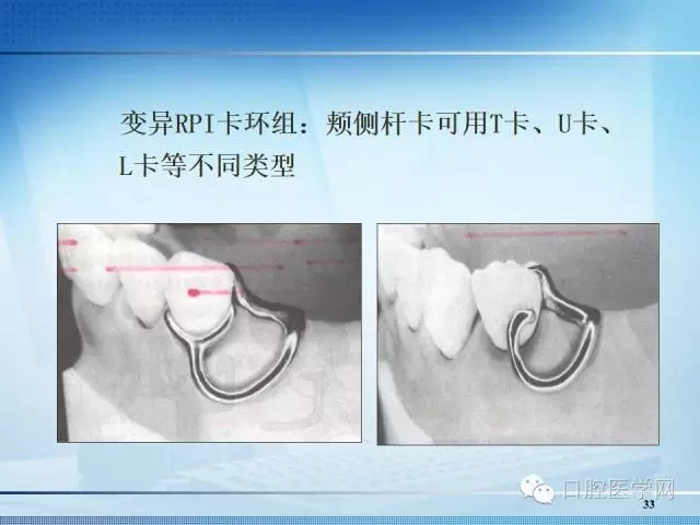 义齿技术 【多图】可摘局部义齿-卡环的种类  来源于口腔医学网