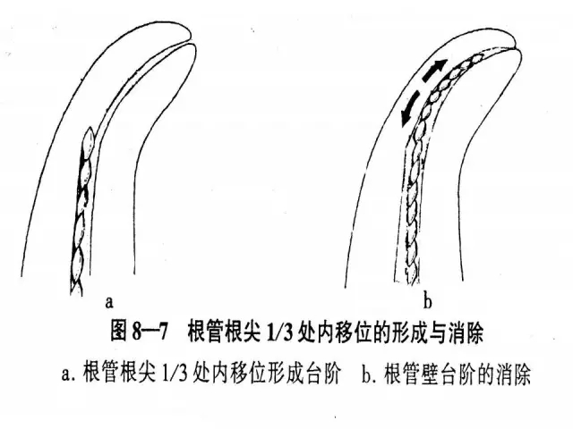 根管治疗并发症及处理