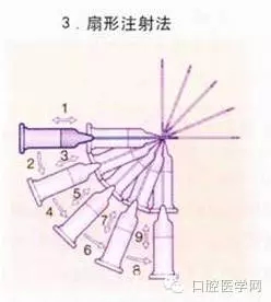 即使是老手也会失手的麻醉----下牙槽、舌、颊一次阻滞麻醉