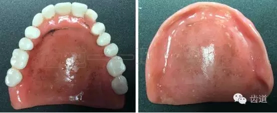 胡常红：疑难全口义齿闭口式印模病例解说