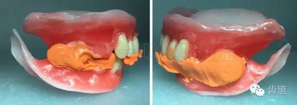 胡常红：疑难全口义齿闭口式印模病例解说(8).jpg