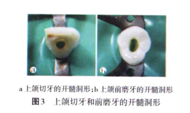 根管治疗中常见操作失误(1) ——开髓不当