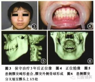儿童口腔下颌骨髁突矢状骨折保守治疗临床观察13年一例