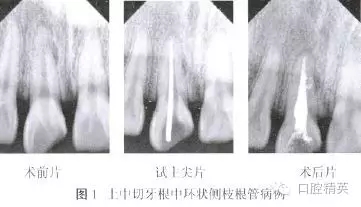 上颌中切牙根中环状侧枝根管1例