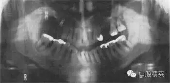 2 患者牙齿的全口牙位曲面体层x线片