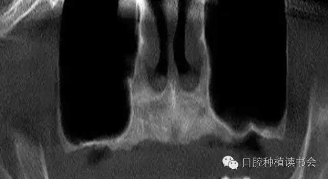 上颌后牙区种植治疗的关键技术之—上颌窦提升术