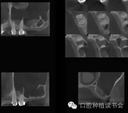 上颌后牙区种植治疗的关键技术之—上颌窦提升术