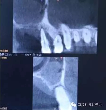 上颌后牙区种植治疗的关键技术之—上颌窦提升术