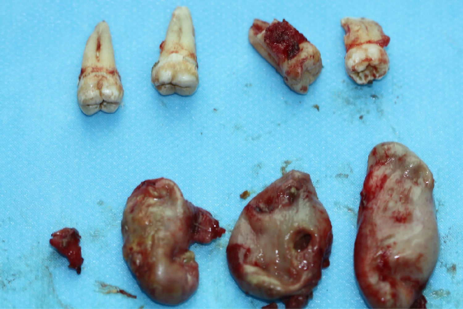 多发性颌骨囊肿综合征一例入院后全麻下手术治疗,左侧下颌骨囊肿较大
