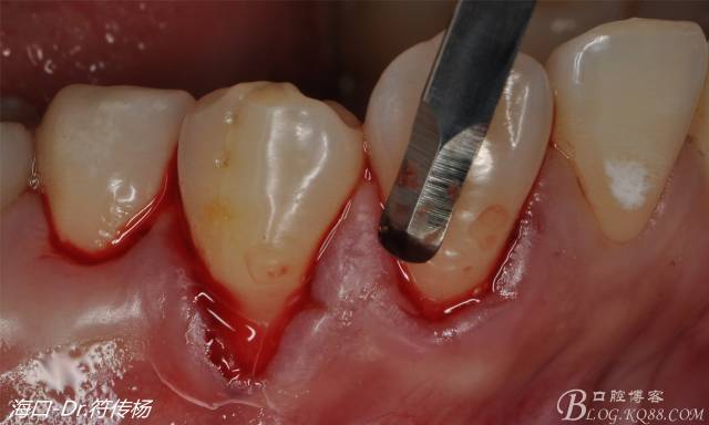 然后使用下颌开隧刀剥离牙龈最后使用牙龈乳头分离器分离牙龈乳头接着