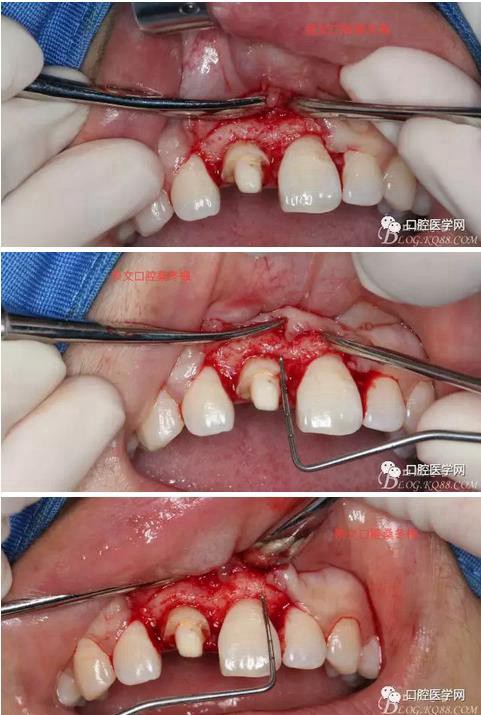 前牙纤维桩折断的残根牙冠延长术后的美容修复