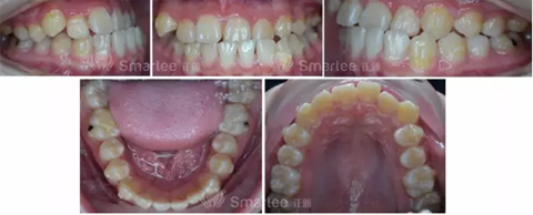 【病例展示】Smartee隐形正畸中国好病例鉴赏第三波