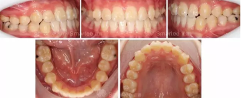 【病例展示】Smartee隐形正畸中国好病例鉴赏第三波