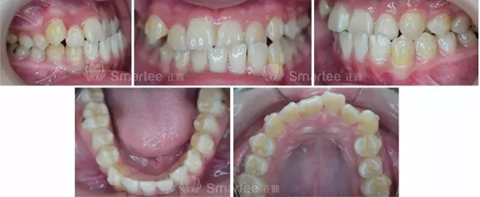 【病例展示】Smartee隐形正畸中国好病例鉴赏第三波