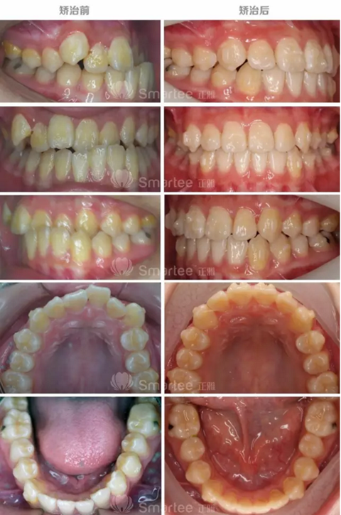 【病例展示】Smartee隐形正畸中国好病例鉴赏第三波
