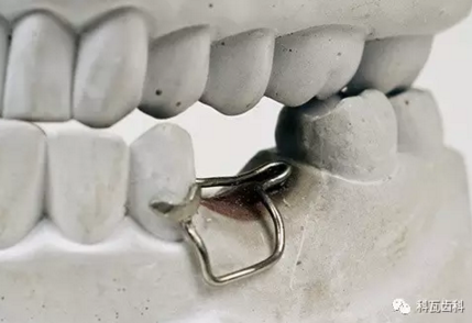 间隙保持器,主要用于失去乳牙的孩子,为了保持这个空缺维持正常的