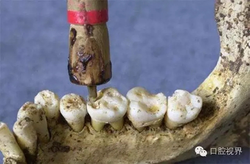 以前牙医是怎样虐待人们牙齿的？ 看完了就知道现在看牙多舒适了！