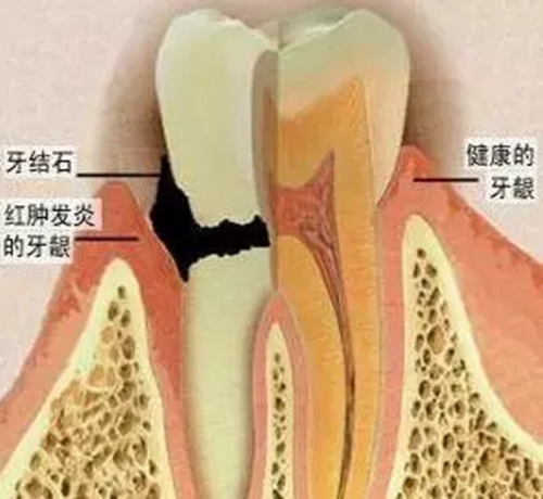 【爱牙科普】口腔谣言终结者——每天刷牙，洗牙该不该？！