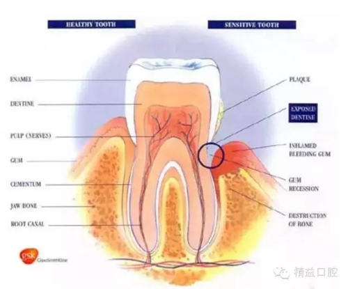 【爱牙科普】口腔谣言终结者——每天刷牙，洗牙该不该？！