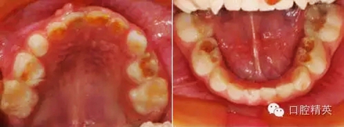 全麻下儿科治疗+儿牙树脂充填