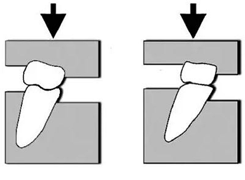 的咬合状态,常见的异常表现是上,下后牙因对刃关系而磨成平面(牙合)