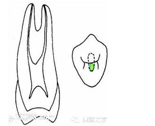 根管治疗之根管口的探查要点  