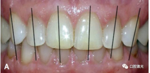 牙龈美雕——口腔激光在口腔正畸中的应用(下篇) 科贸嘉友收录
