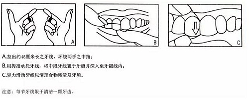 牙周病患者的外提升 梁光强