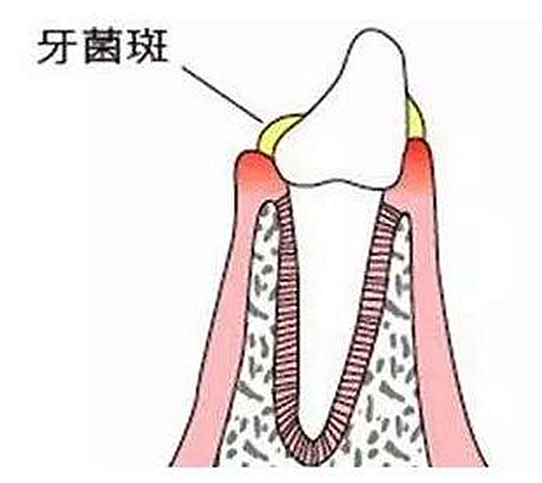 牙周病患者的外提升 梁光强