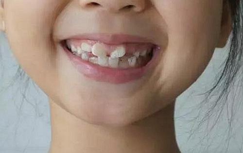小孩正处于换牙期,青少年是牙齿矫正黄金时期,如果孩子出现牙齿不齐