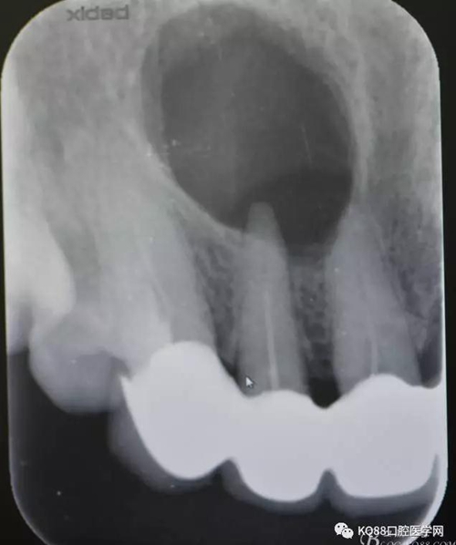 上颌侧切牙根尖手术——张东星  