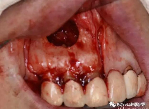 上颌侧切牙根尖手术——张东星  